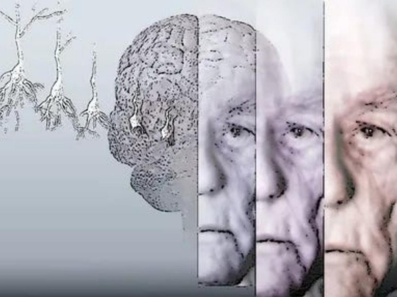 Perché non c’è una cura per la malattia di Alzheimer?